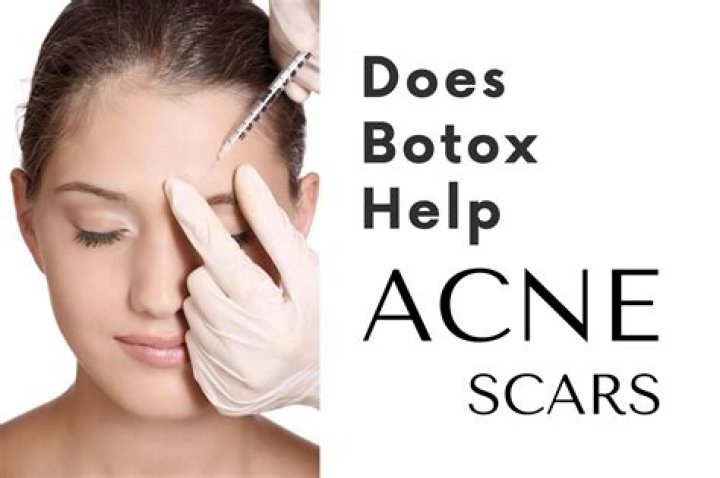 Does botox help acne?