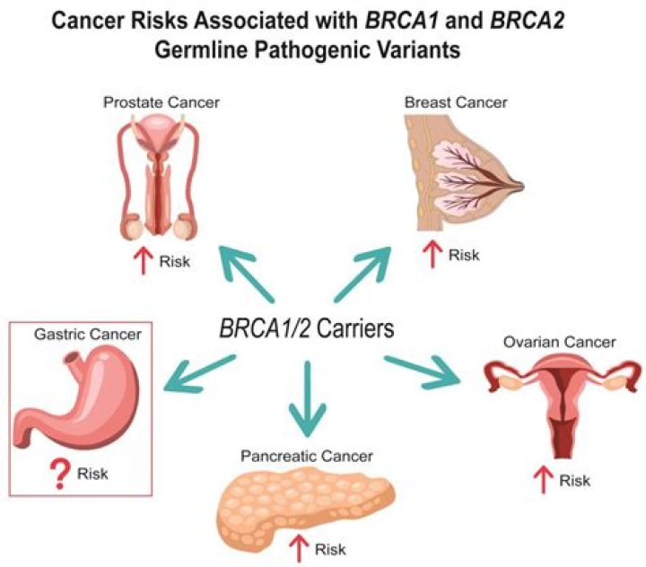 Does brca1 cause ovarian cancer?