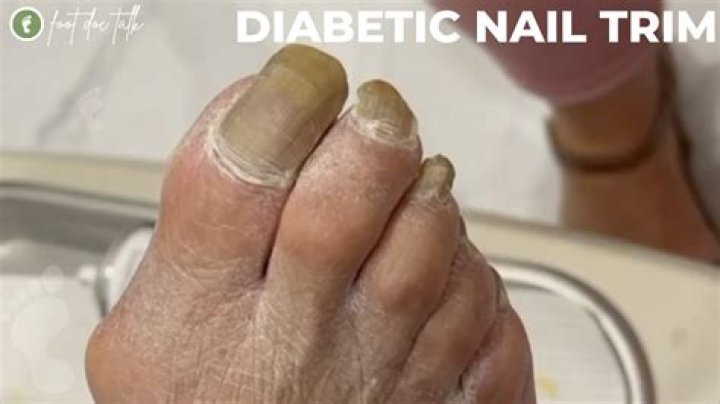 Does chiropodist cut toenails?