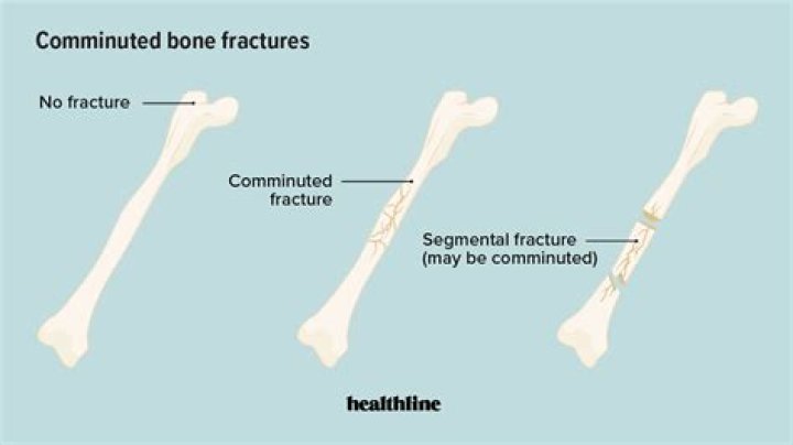 Does comminuted fracture mean displaced?