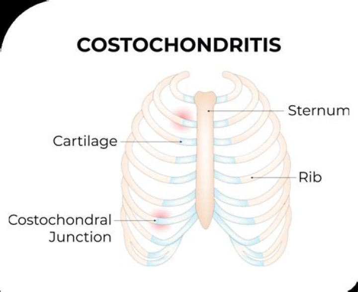 Does costochondritis ever go away?