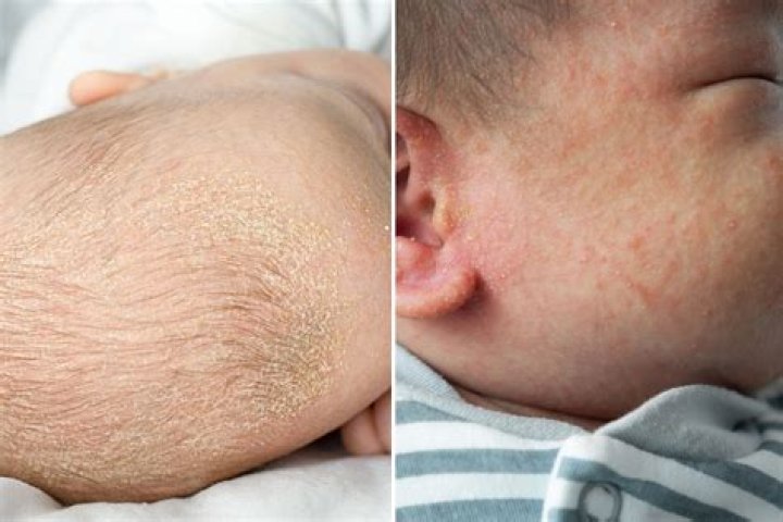 Does cradle cap itch babies?