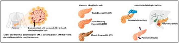 Does distal pancreatectomy cause diabetes?