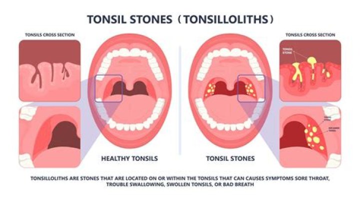 Does everyone get tonsil stones?