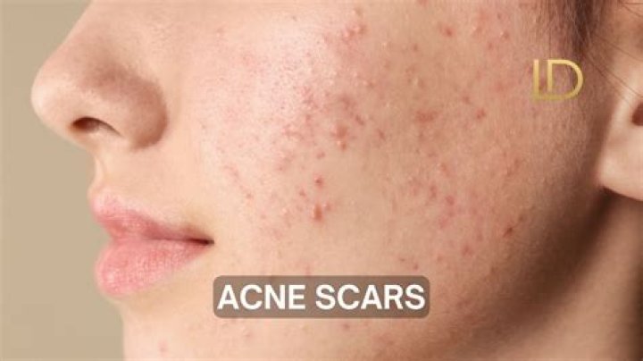 Does gainer cause acne?