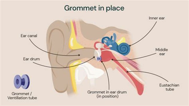Does grommet affect hearing?