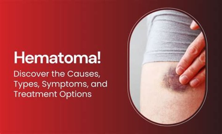 Does hematoma cause bleeding?