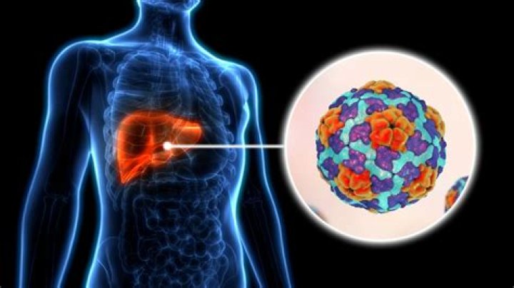 Does hepatitis a cause hepatocellular carcinoma?