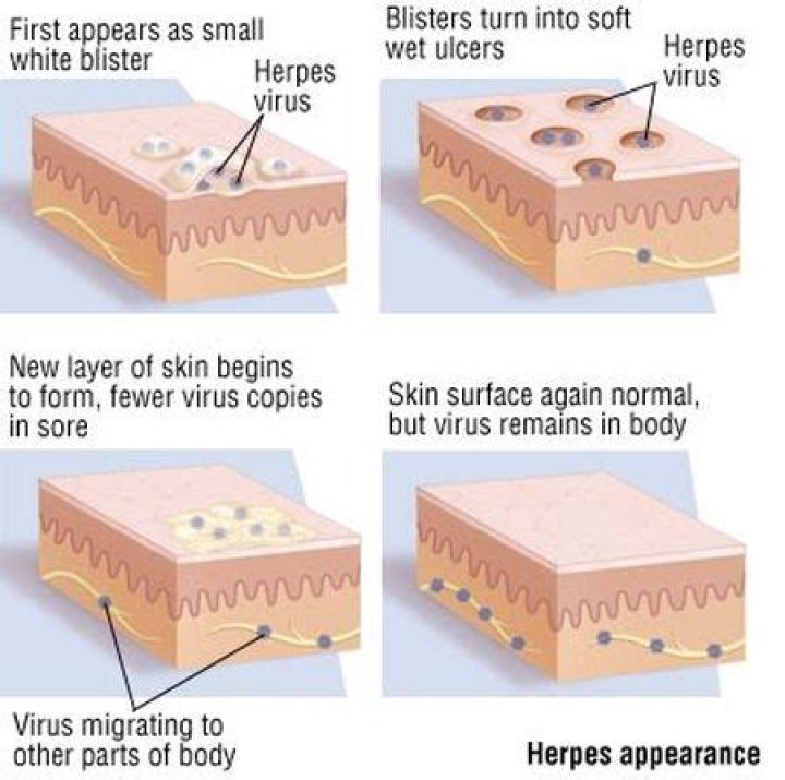 Does herpes spread over the body?
