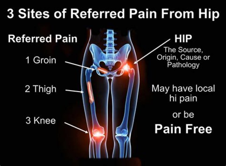 Does hip pain referred to knee?