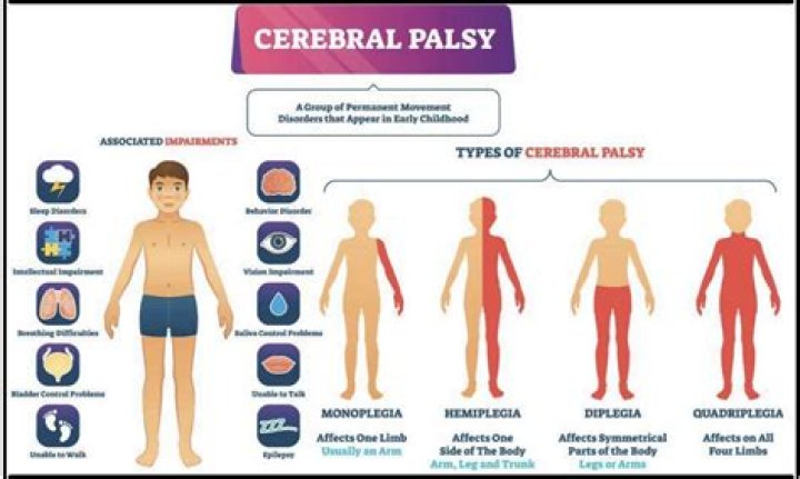 Does hypotonia mean cerebral palsy?