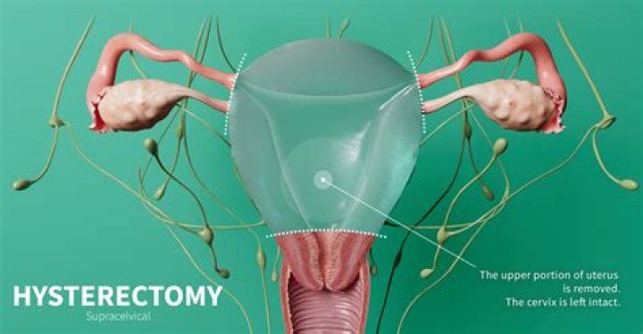 Does hysterectomy cause dyspareunia?