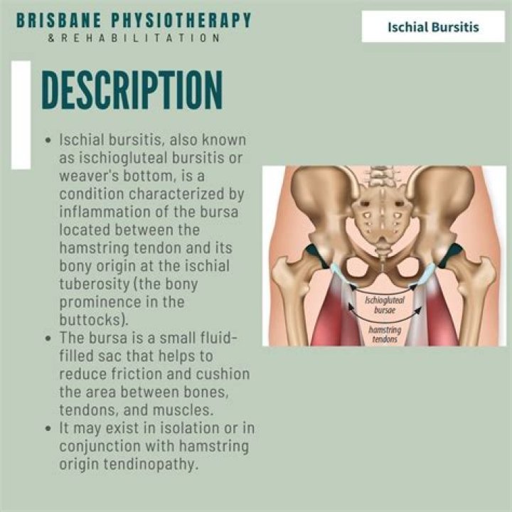 Does ischial bursitis go away?