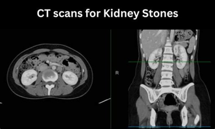 Does iv contrast obscure kidney stones?