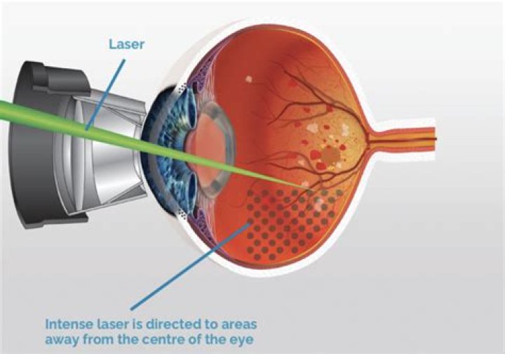 Does laser photocoagulation hurt?