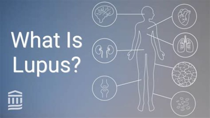 Does lupus cause unexplained bruising?