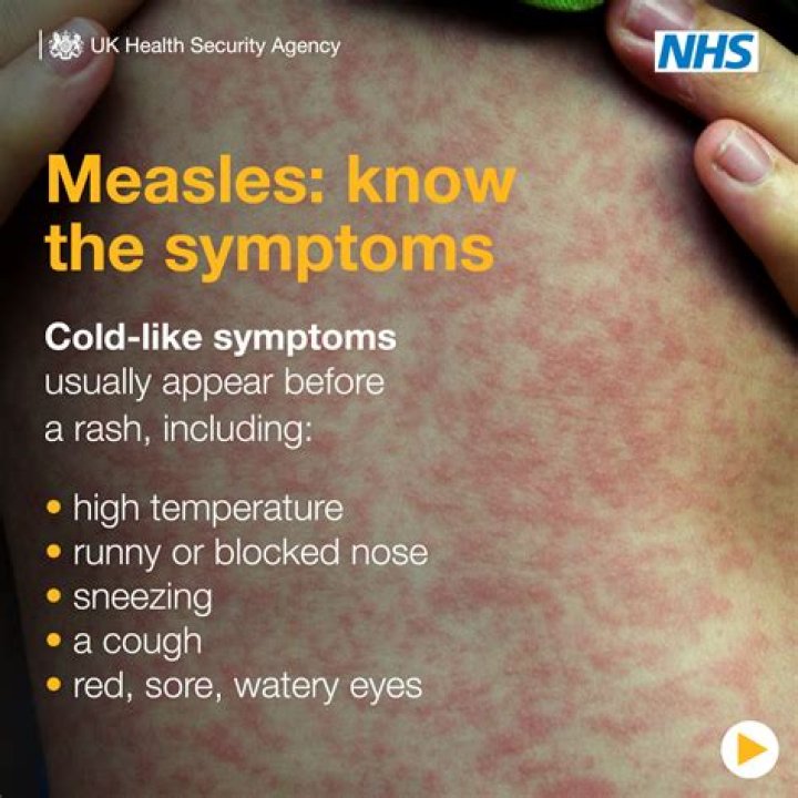 Does measles rash itch?