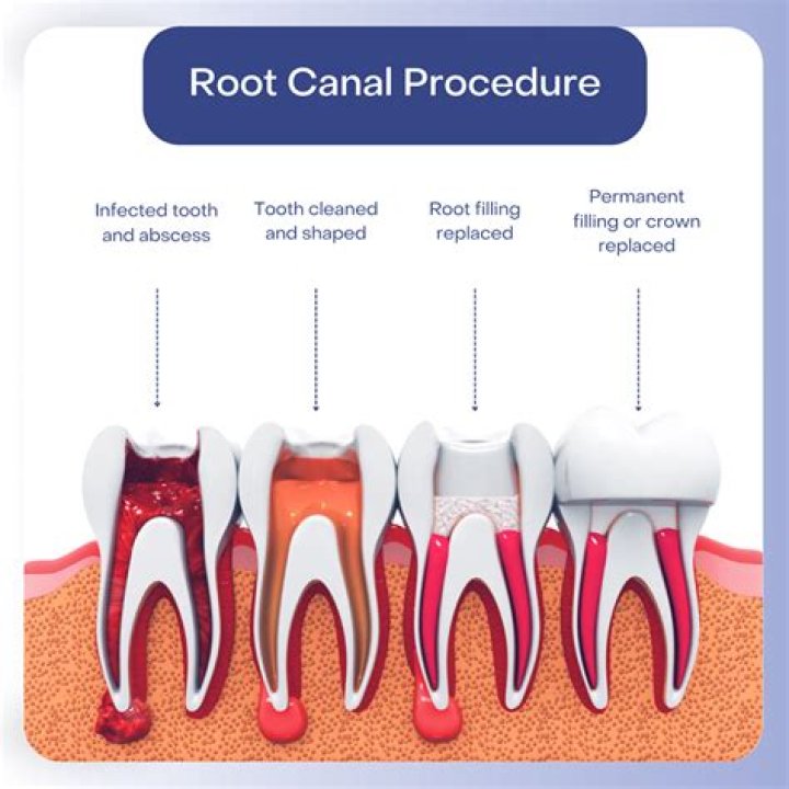 Does medical cover root canals?