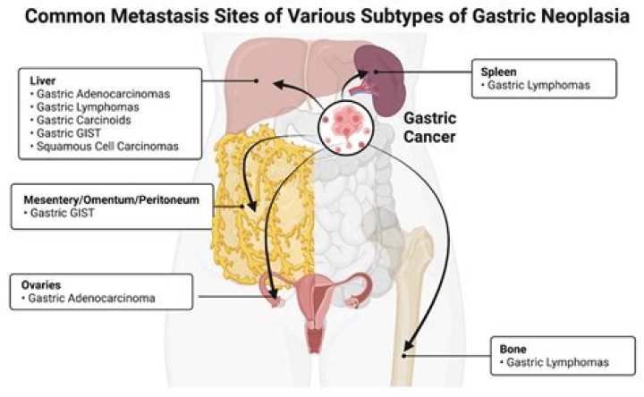 Does metastasis grow fast?