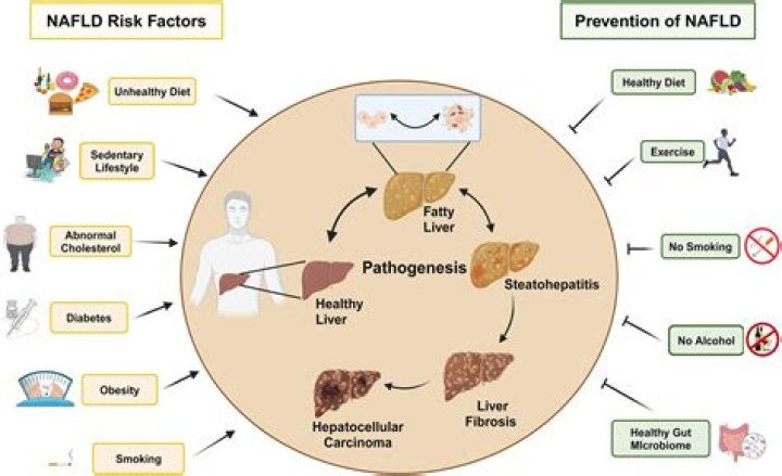 Does nafld go away?