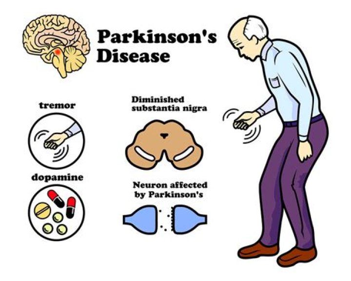Does parkinson's start in one hand?