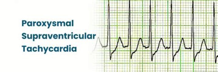 Does paroxysmal supraventricular tachycardia go away?