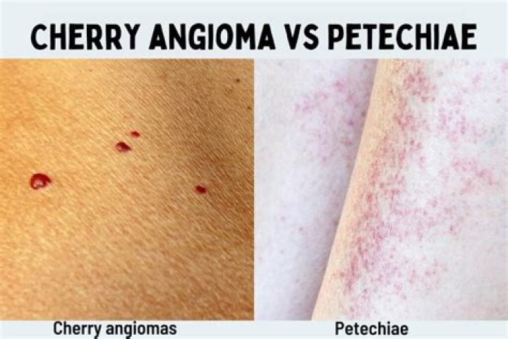 Does petechiae go away?