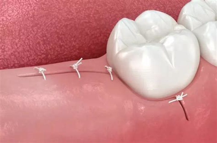 Does removal of stitches hurt?