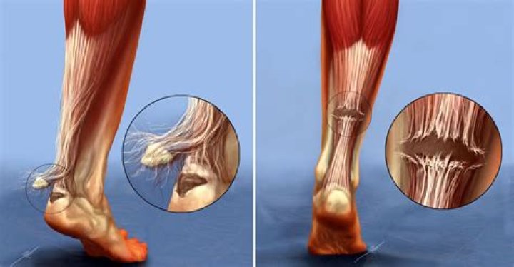 Does rupturing your achilles hurt?