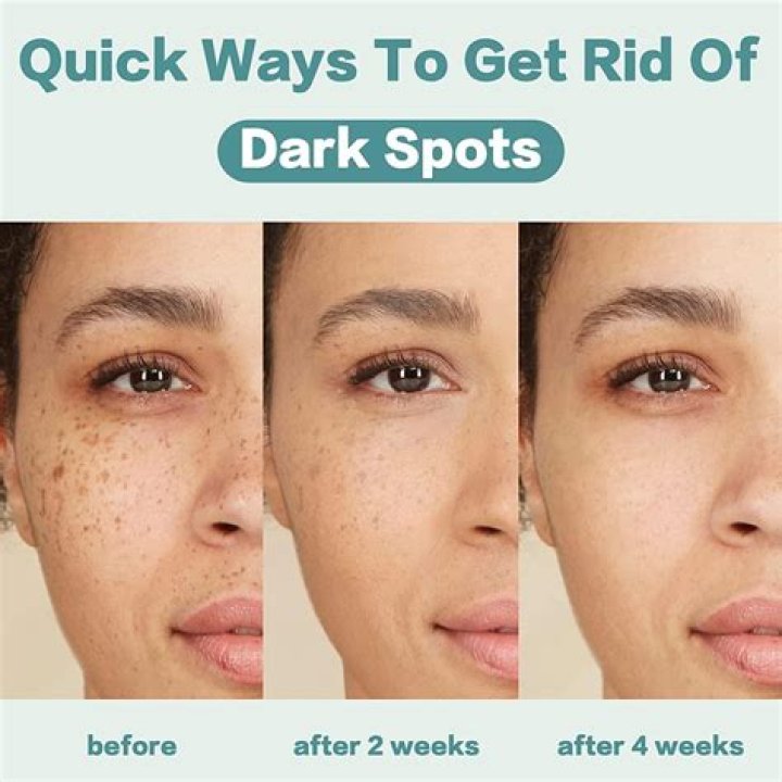 Does sandalwood remove dark spots?