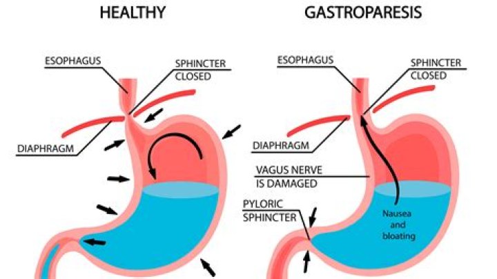 Does saxenda slow gastric emptying?