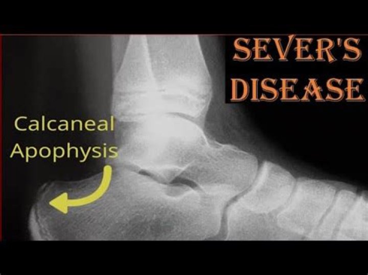 Does severs disease show on x ray?