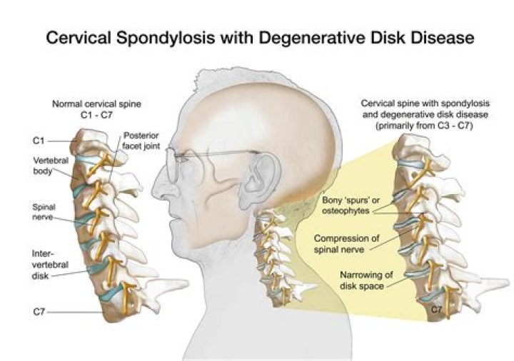 Does spondylosis cause dizziness?