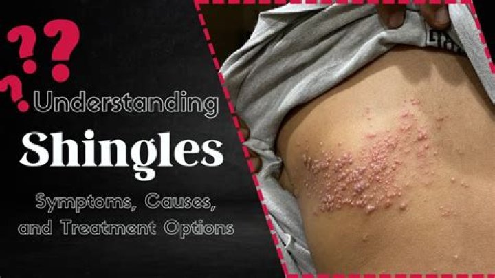 Does stress cause shingles?