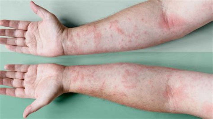 Does sugar cause atopic dermatitis?