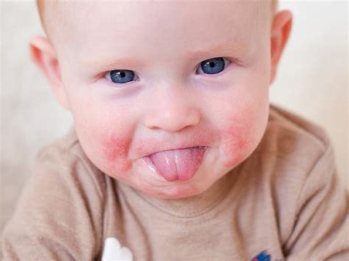 Does teething cause red cheeks?
