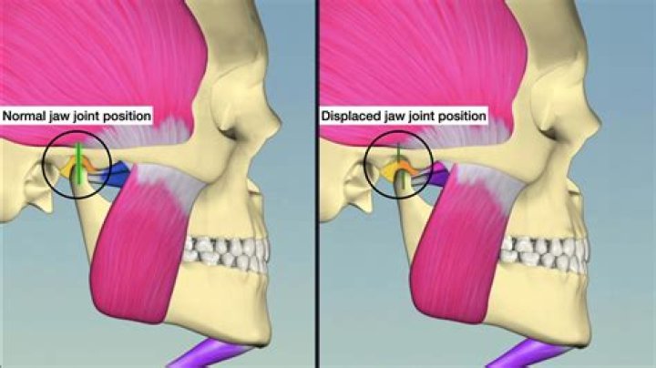 Does temporomandibular joint disorder go away?