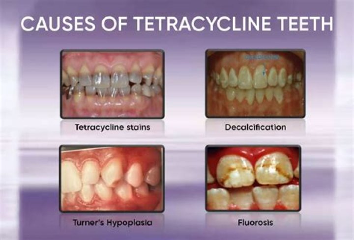 Does tetracycline cause tooth discoloration?