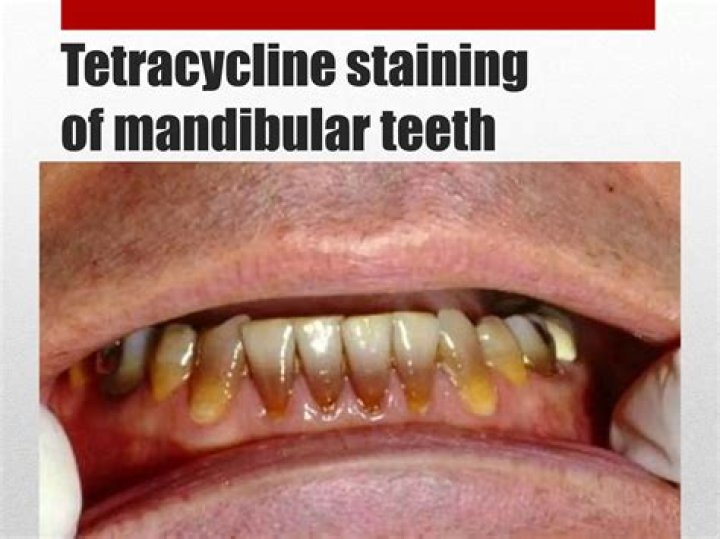 Does tetracycline stain teeth in adults?