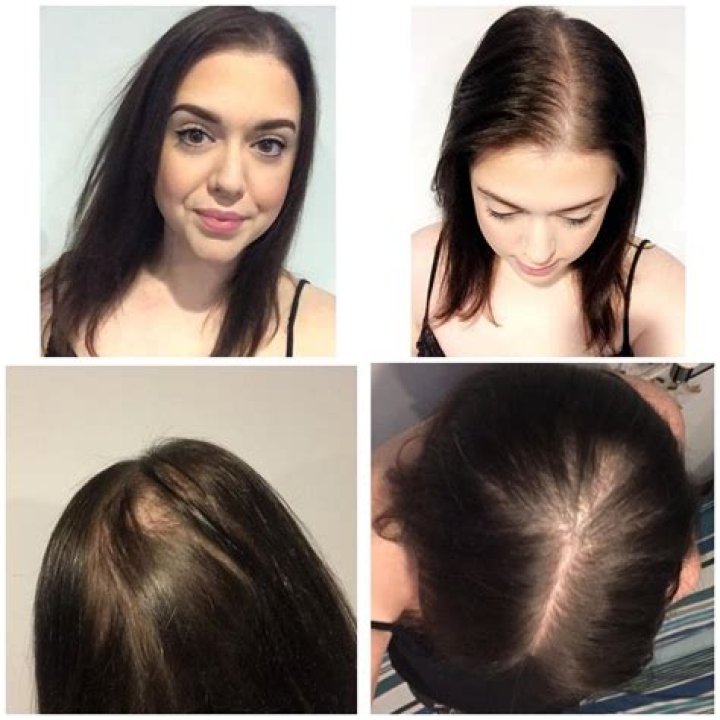 Does thinned out hair grow back?