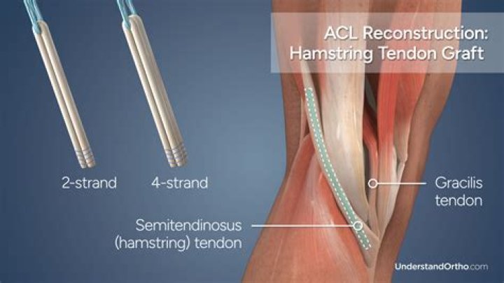 Does torn quadriceps tendon require surgery?