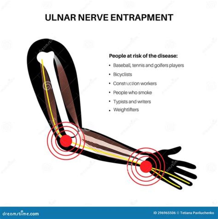 Does ulnar nerve entrapment go away?