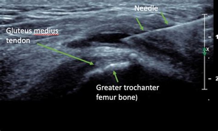 Does ultrasound help trochanteric bursitis?
