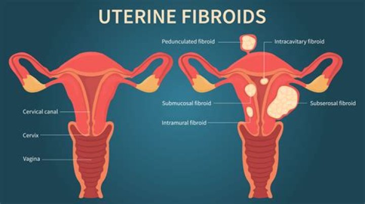 Does uterine fibroids cause cancer?