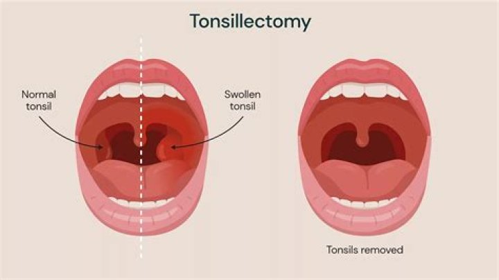 For my swollen tonsils?