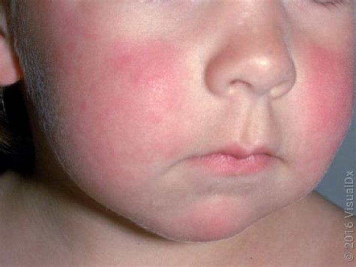 Has a swollen cheeks?
