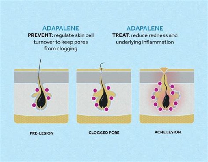 How adapalene gel works?