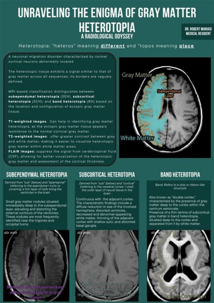 How common is grey matter heterotopia?