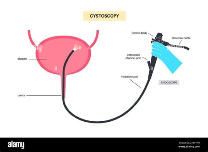 How cystoscopy is performed?