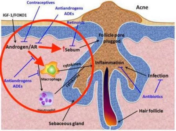 How do androgens cause acne?